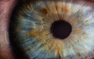 Age Related Macular Degeneration (AMD)